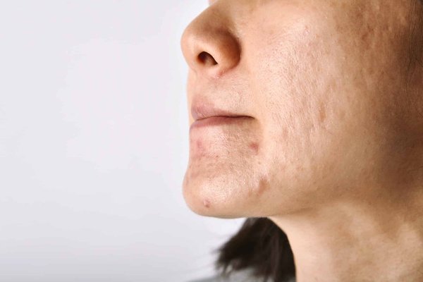 Peau à tendance acnéique : les meilleurs remèdes naturels